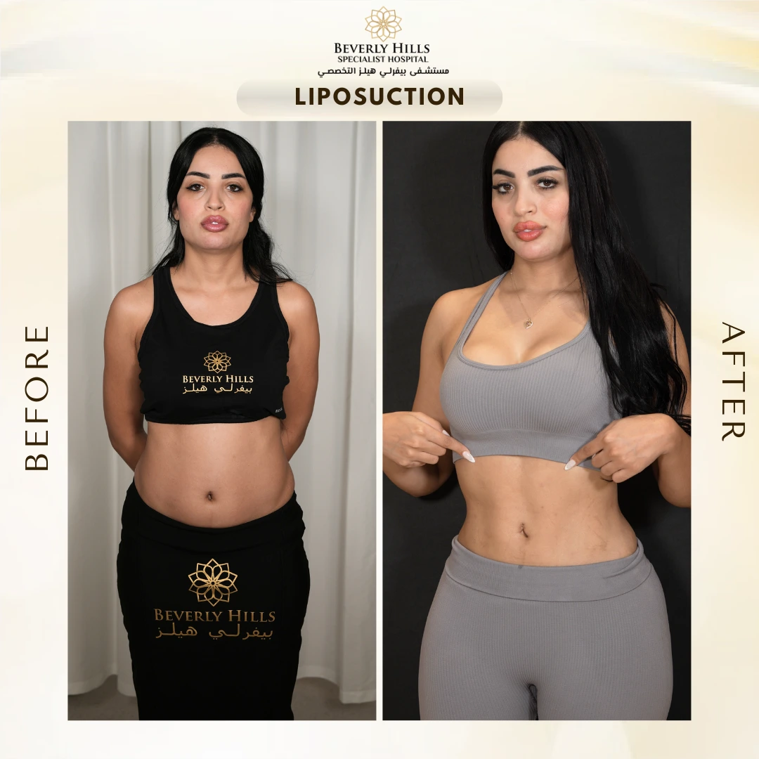 شد كامل للبطن + نحت رباعي الأبعاد + تقنية كيم كارداشيان